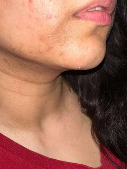 post wearing nua pimple patch
