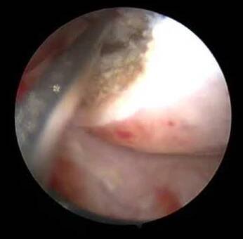 endoresekce polyp 3cm
