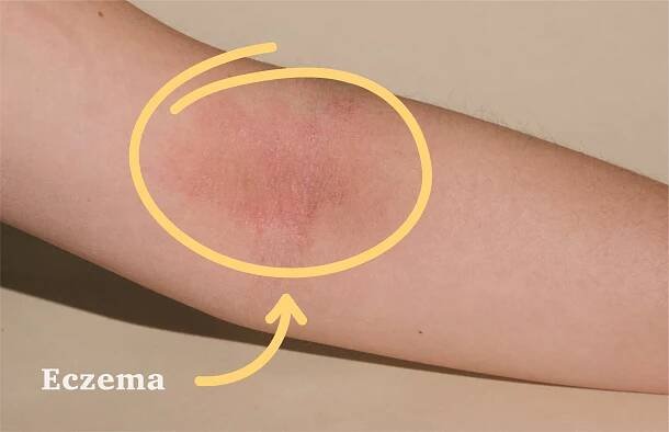 an arm is seen displaying a condition of eczema