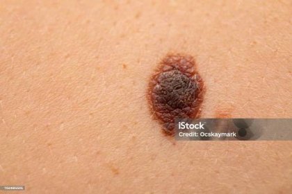 Nebezpečný névus na kůži - melanom - Bez autorských poplatků Melanom - Rakovina kůže Stock fotka