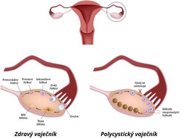 Polycystické vaječníky (syndrom polycystických ovarií)