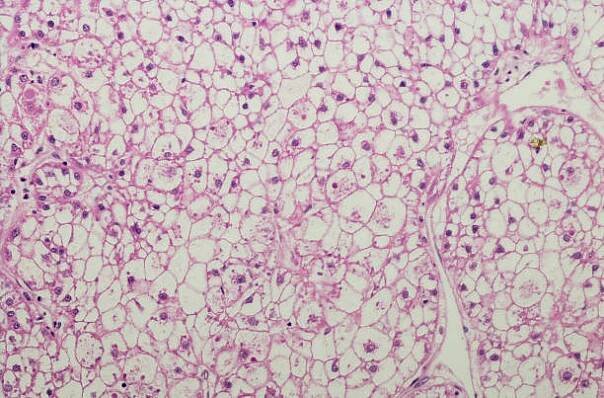 čirý buněčný hepatocelulární karcinom, karcinom jater - cirhózami - stock snímky, obrázky a fotky