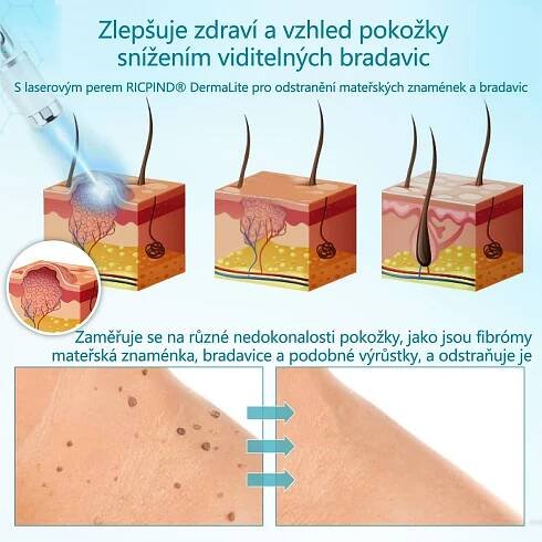 RICPIND® DermaLite Multifunkční laserové pero na odstranění bradavic a obnovu pleti🌿