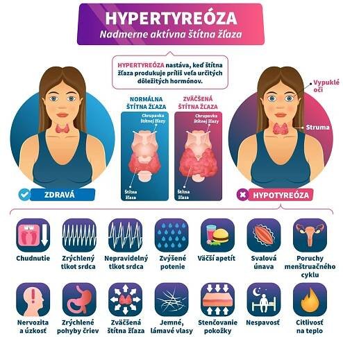 Infografika o hypotyreóze, pri ktorej štítna žľaza produkuje nadmerné množstvo určitých hormónov.