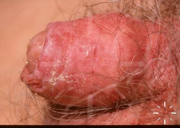 DermaCompass - Extramammary Paget's disease 