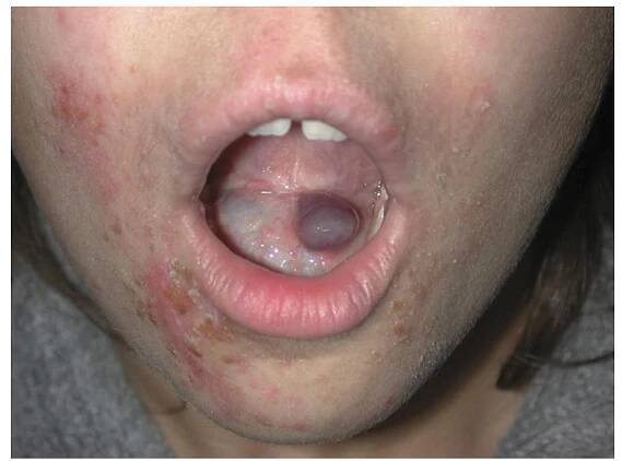 Fig. 5 Case no. 8: right relapsed ranula with left ema- toma after two marsupializations.  Nickel is considered an essential element [8]. The human body normally contains 10 mg nickel. It accu- mulates in pancreas, bones, arteries but it is found even in sweat, saliva and serum. Oysters, herrings, 