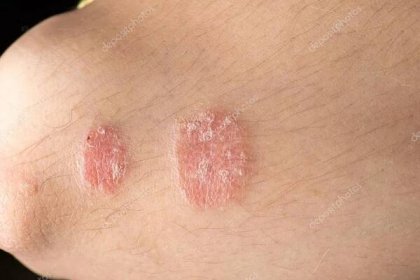 Kožní onemocnění lupénka — Stock obrázek