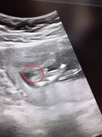 Těhotenství | Bude to kluk nebo holka?