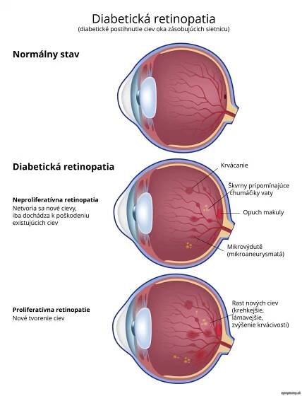 Diabetická retinopatia