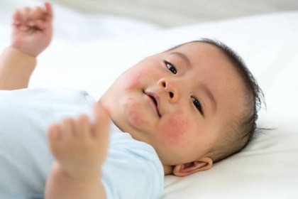 dítě má alergickou reakci na obličej, kožní vyrážky u konceptu dětí - vyrážka - stock snímky, obrázky a fotky
