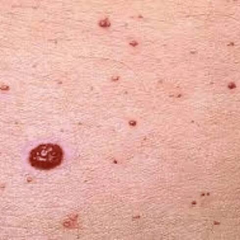 Huidoneffenheden – Total Skin Clinic