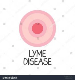 Stock vektor „Lyme Disease Text Erythema Migrans Rash“ (bez autorských poplatků) 1825326536