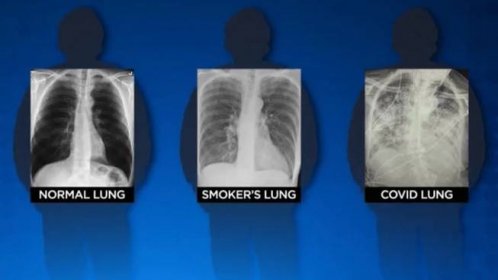 Covid může poškodit plíce i pacientovi bez příznaků, varuje expertka