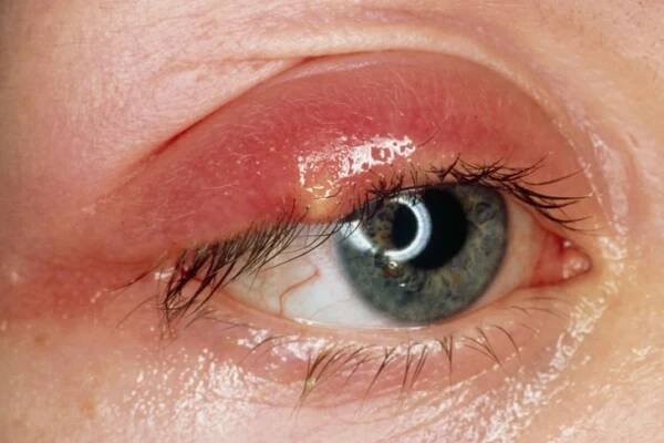 Bacterial Infection