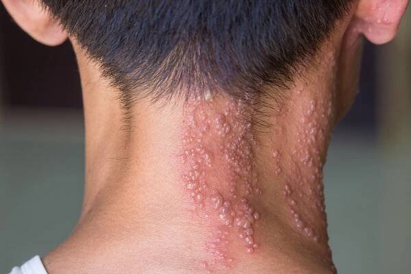 Shingrix: Excellent Vaccine Against Shingles