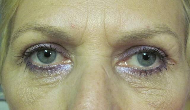 Eyelid Rejuvenation New York City, Botox Juvederm Manhattan