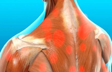 Myofascial Trigger Pain Affecting The Trapezius Muscle