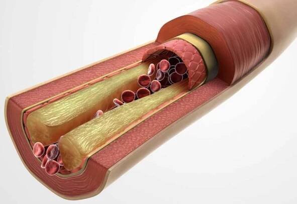 5 doplňků a bylin, které pomáhají snižovat hladinu cholesterolu při ateroskleróze / Články