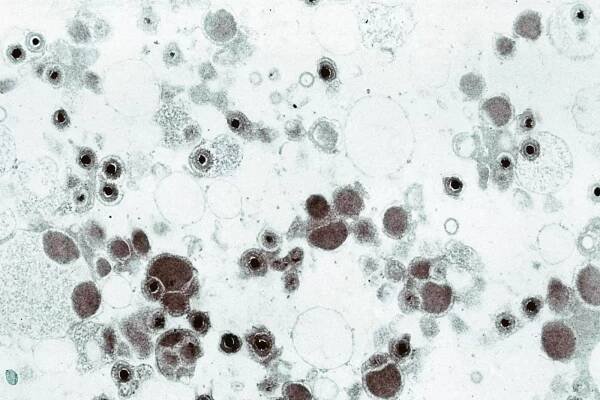CytomegalovirusVaccine.jpg