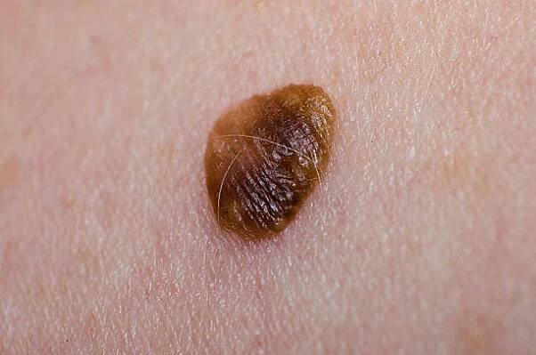 mateřské znaménko nebo papilom nebo keratopapillom na lidské kůži zblízka - hairy nevus - stock snímky, obrázky a fotky