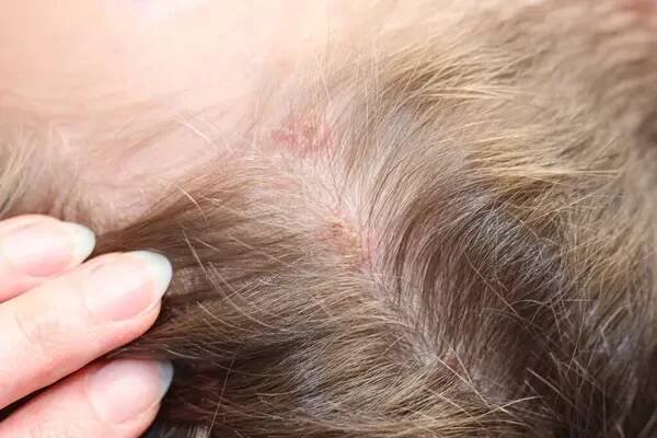 To dítě je nemocné neštovicemi. Chlapec má vyrážky po celém těle, dokonce na hlavě, které jsou neuvěřitelně svědivé a bolestivé. — Stock obrázek