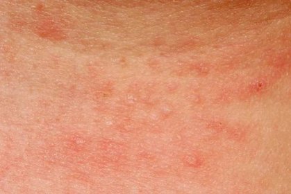 Alergická vyrážka dermatitida kůže textura pacienta — Stock obrázek