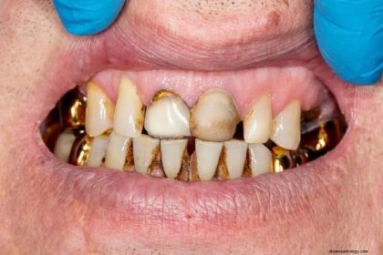 Zkažený zub – význam snu a symbolika