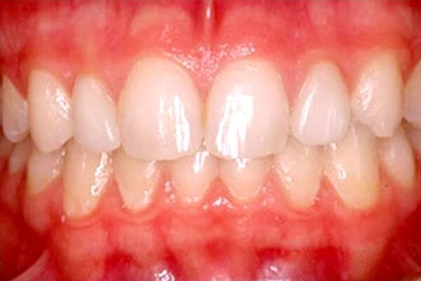 Seeing is Believing - Amazing KöR Whitening Results