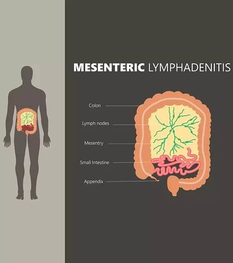 Mesenteric Lymphadenitis In Children: Complete Guide