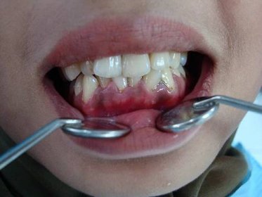 Zánět dásní - gingivitida