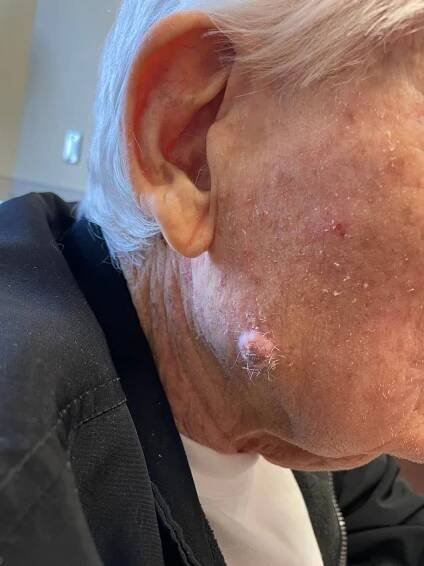 An image of an old man's face showing a pink plaque and tumor.