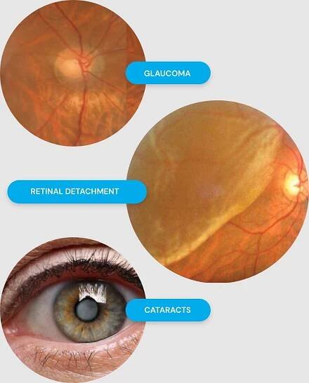 Myopia image risk and reasons