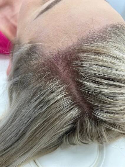 Before/Afters | GLANZ Aesthetics | Doral, FL