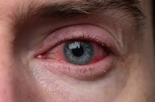 A close up of a man's eye who is suffering from Bacterial Conjunctivitis (Pink Eye)