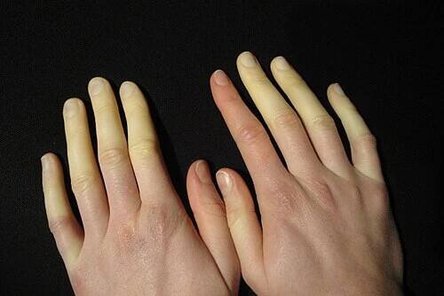Raynaudova nemoc – Wikipedie