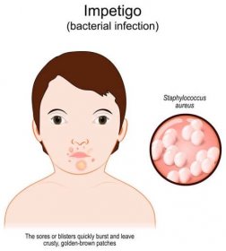 impetigo. obličej dítě s kožní infekcí - impetigo stock ilustrace