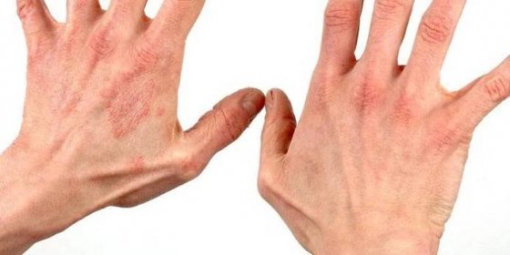 Ruce se suchou bolestí kůže