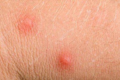 Stáhnout - Makro pupínky alergie na mužské pokožky rukou — Stock obrázek