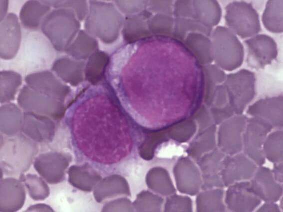 Brněnští vědci mají novou metodu léčby leukemie