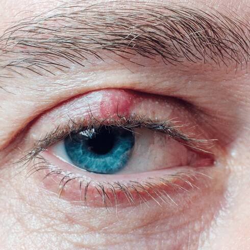 the chalazion