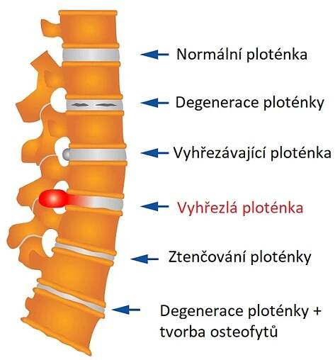 Jak vypadá vyhřeznutí ploténky?