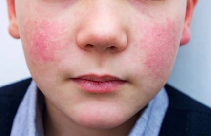 8 let dítě s červenými tvářemi - enterovirová infekce, diatéza nebo příznaky alergie. zarudnutí a odlupování kůže na obličeji. - puchýř trauma - stock snímky, obrázky a fotky