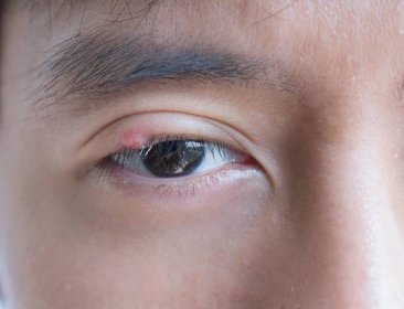 zblízka asijského mladého muže s hnědým okem s infekcí stye. absces očních víček, hordeolum v lékařském zdraví, nemoci a koncepci léčby. - ječné zrno - stock snímky, obrázky a fotky