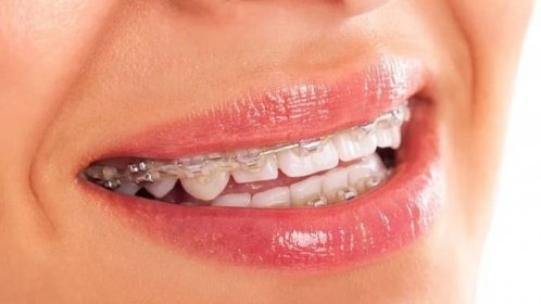 Křivé zuby má smysl řešit nejen v dětském věku