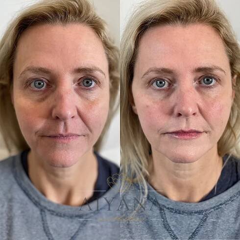 Dermal filler at AIYANA