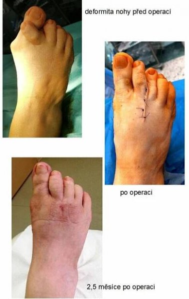 HALLUX VALGUS – Ortopedie Frydrych