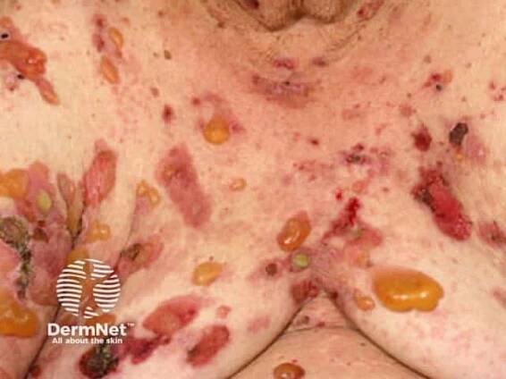 Bullous Pemphigoid: Causes, Symptoms, and Treatment — DermNet