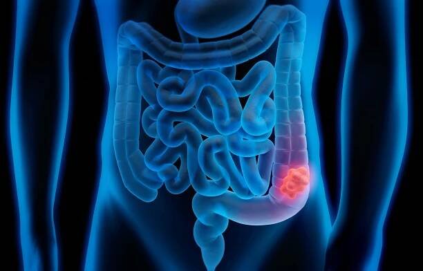 Medical illustration of colorectal cancer.