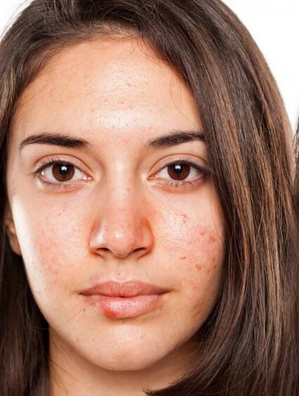 Red Pimples On Face Treatment – 07 Best And Trusted Ways