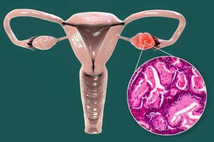 Consider Fallopian Tube Removal to Avoid Ovarian Cancer